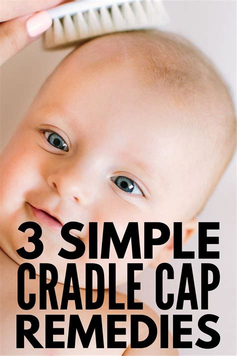 Cradle Cap 101 3 Natural Cradle Cap Remedies That Work Artofit