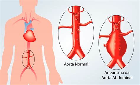 Aneurisma Da Aorta Abdominal Aaa Causas Sintomas E Tratamentos Hot Sex Picture