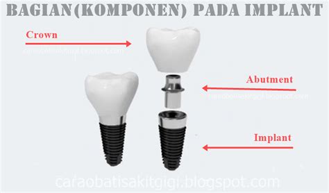 Implant gigi (dental implant) implant gigi merupakan gigi palsu permanen yang ditanam dalam gusi dan berdiri sendiri. 6 Macam Jenis Gigi Palsu (Permanen, Lepasan) dan Bahan ...