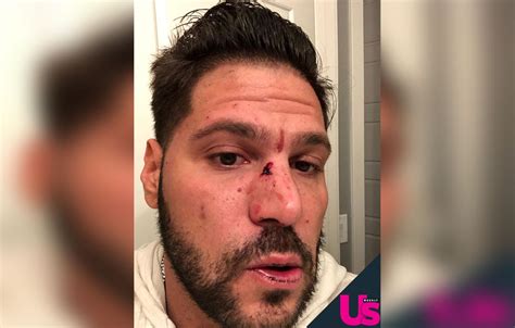 Gruesome Pics Ronnie Ortiz Magros Face After Alleged Jen Harley Fight