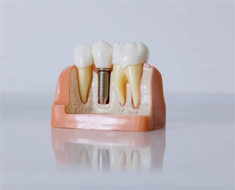 Impresión 3d Dental Custom 3d