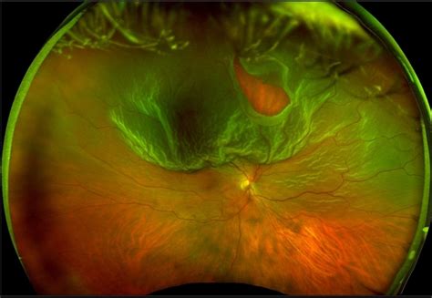 Retinal Detachment What You Need To Know About A Detached Retina