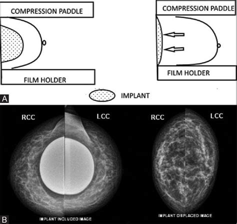 Breast Implants Breast Cancer And Screening