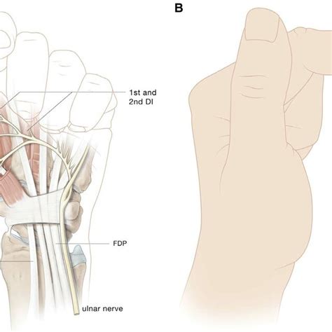 Claw Hand For Distal Ulnar Nerve Injury Or Chronic Compression Loss Of