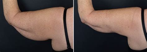 Arm Lift Anderson Sobel Cosmetic Surgery Arm Lift Surgery Arm Lift