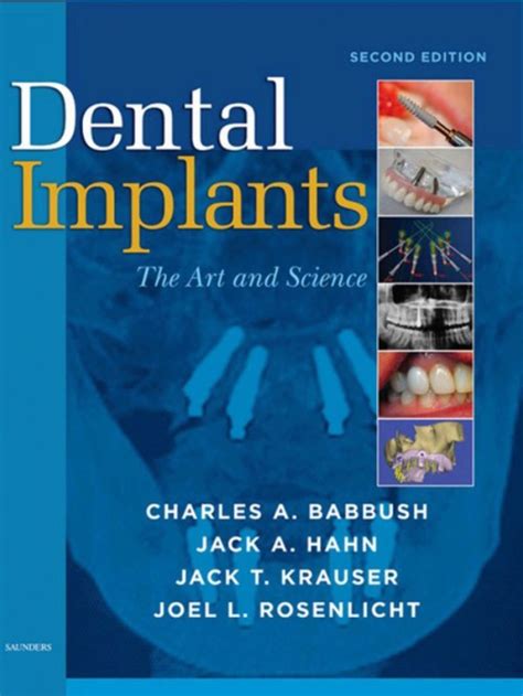Dental Implants Ebook En Laleo
