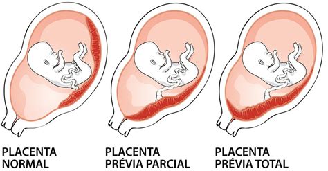 It plays critical roles in facilitating nutrient, gas and waste exchange between the physically separate maternal and fetal circulations. Saiba o que é placenta prévia