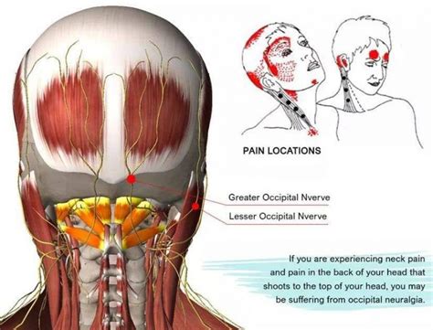 What Is Occipital Neuralgia And Symptoms To Diagnose