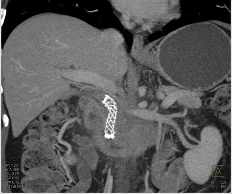 Stent In Common Bile Duct In Patient With Pancreatic Cancer Pancreas