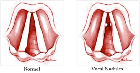 How Can I Tell If I Have Vocal Nodules