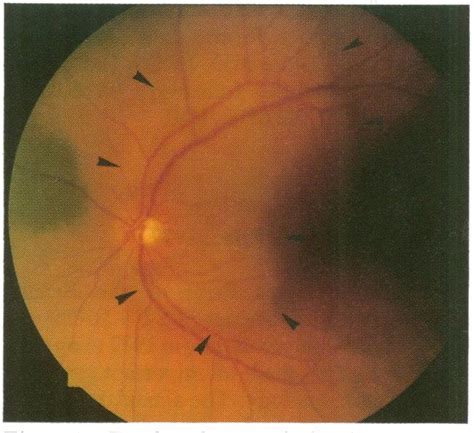 Fundus Photograph Showing A Choroidal Metastasis Superotemporal To The