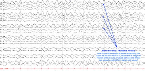 Eeg Terminology And Waveforms