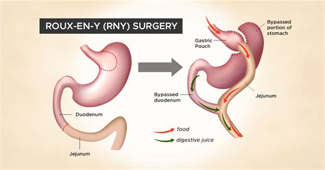 How A Stomach Is Rearranged In Rny Surgery For Weight Loss Obesityhelp