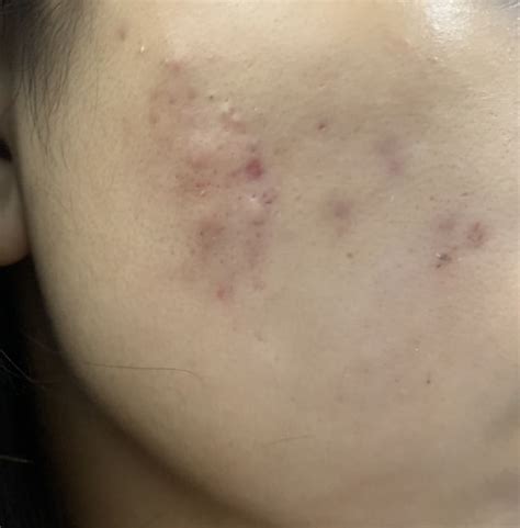 Treatment for acne macules is different from treatment for acne scars. How do I get rid of red acne scars due to active outbreaks ...
