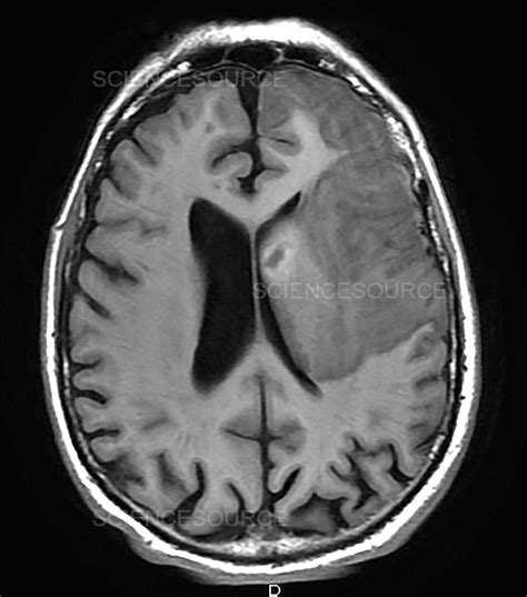 Hemorrhagic Stroke Mri