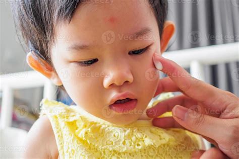 Mother Applying Antiallergic Medicine Cream At Cute Asian Girl Face
