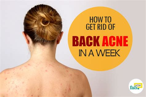 How To Get Rid Of Back Acne In A Week Fab How