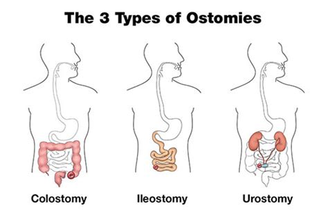 The 3 Types Of Ostomies Hollister Uk