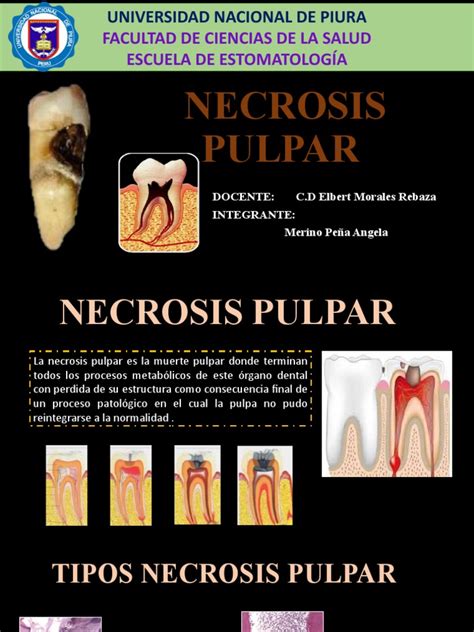 Necrosis Pulpar Pdf Enfermedades Y Trastornos Medicina Clinica