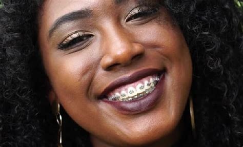 Why You Should Not Get Your Braces From A Public Hospital In Nigeria