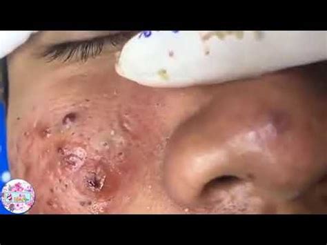 In the latest edition of the best pops, dr. Worst Case Removal Blackheads On The Face How To Remove ...