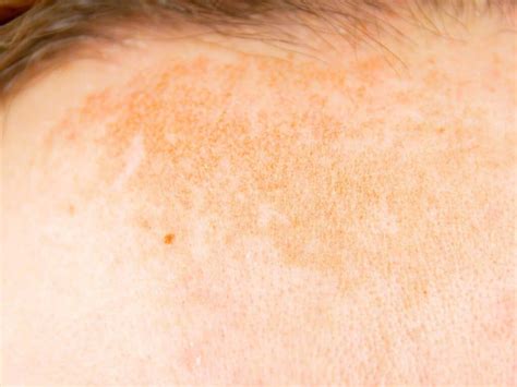 Brown Patches On Skin Spots Causes Get Rid Remedies Treatment