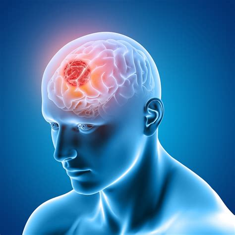Tumor Cerebral ¿cuáles Son Los Síntomas Neuro Lab