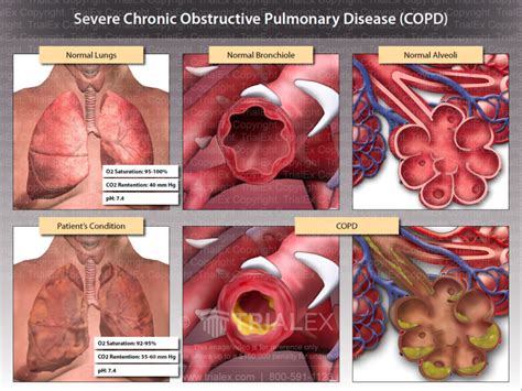 Severe Chronic Obstructive Pulmonary Disease Trial Exhibits Inc