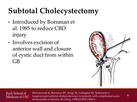 Socal Acs 2014 Subtotal Cholecystectomies