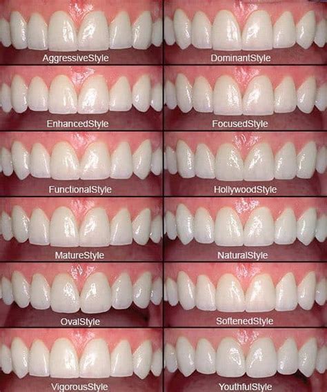 Everything You Need To Know About Dental Veneers Bdg