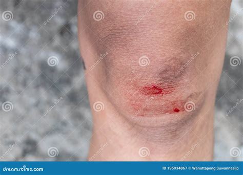 The Knee Is Scratched Close Up On An Bleeding Scraped Child His Knee
