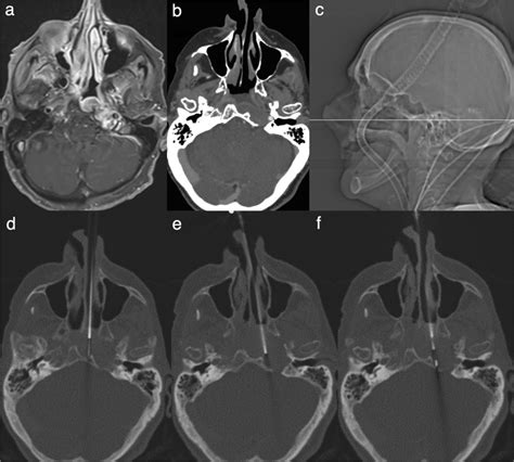 Transnasal Access To The Upper Nasopharynx And Left Basioccipital Bone