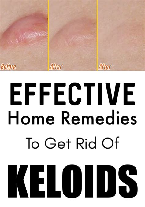 How To Remove Keloids Permanently Howtoremvo