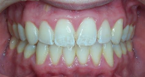 4 Common Tooth Enamel Erosion Symptoms Listerine