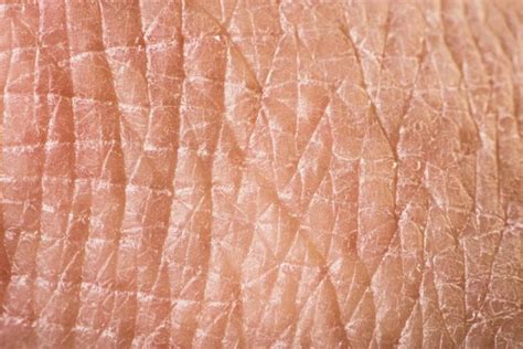 How To Treat Dry Red Flaking Skin Livestrongcom