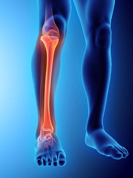 tibial fracture causes symptoms diagnosis and treatment 2023