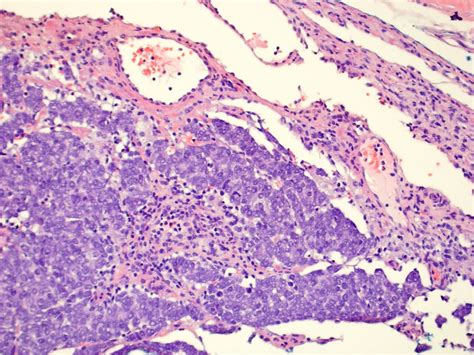 Merkel Cell Tumour Pathology Outlines Pathology Outlines Basal Cell