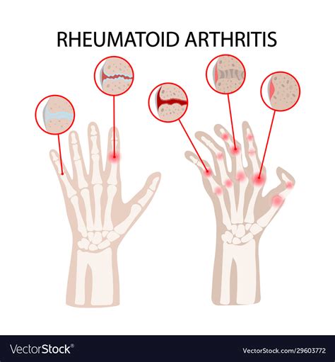 Rheumatoid Arthritis Disease Medicine Education Ve