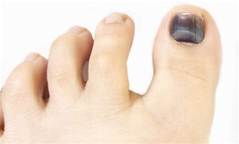 Can Diabetes Cause Toenails To Turn Black Scary Symptoms