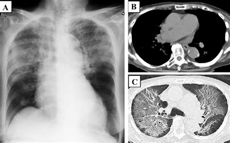 A Chest Radiography Showed Bilateral Ground Glass Opacities