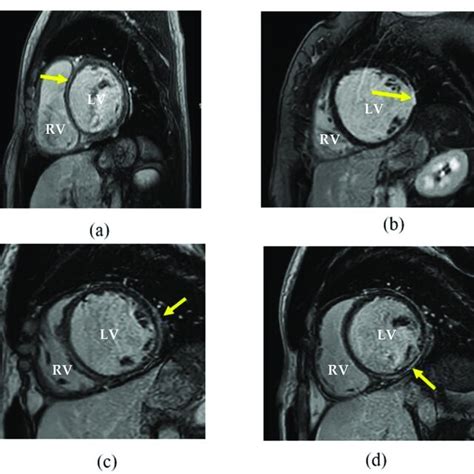 Late Gadolinium Enhancement Cardiovascular Magnetic Resonance Images