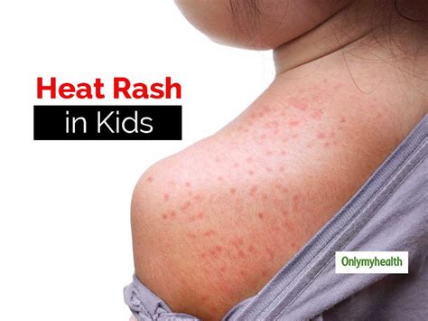 Heat Rash On Body What 10 Common Skin Rashes Look Like Rogers Adds