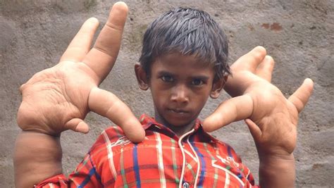 Mystery Condition Gives Indian Boy Gigantic Hands Reckon Talk