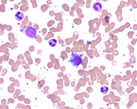 Micromegakaryocytes In Peripheral Blood Smear 1