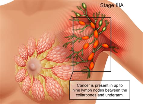 Breast Cancer Signs Symptoms Stages Treatment About
