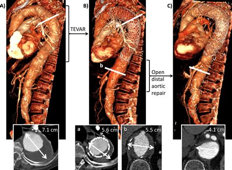 Staged Hybrid Approach Using Proximal Thoracic Endovascular Aneurysm