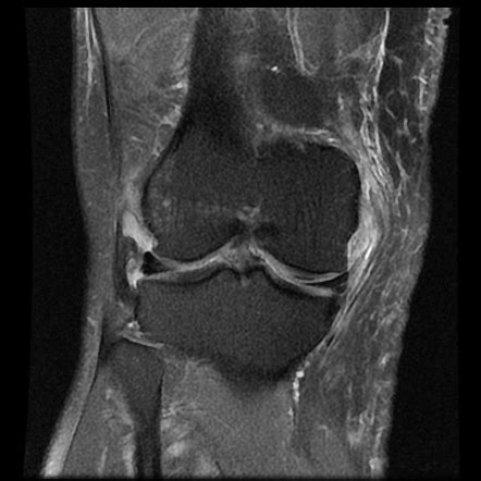 Medial Collateral Ligament Tear Radiology Case Radiopaedia Org