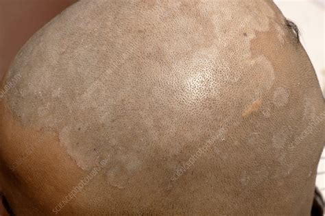 Seborrheic Dermatitis Stock Image C0530709 Science Photo Library