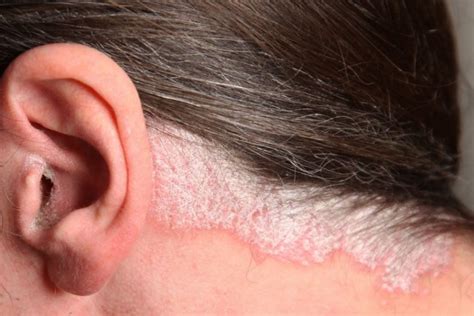 Psorijaza Uzroci Simptomi I Metode Tretmana 101 Hair Clinic