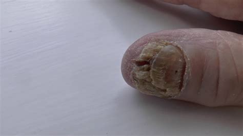 Severe Fungal Nail Infection Affecting Mainly The Thumb Nail Youtube